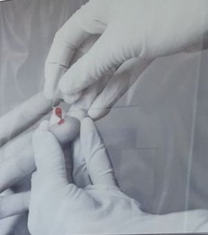 dłonie pielęgniarki w gumowych rękawiczkach oraz dłoń osoby oddającej krew